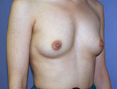 Patient # 40255 Before Photo # 3